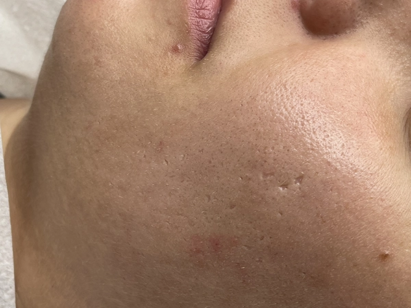 acne scar hertfordshire