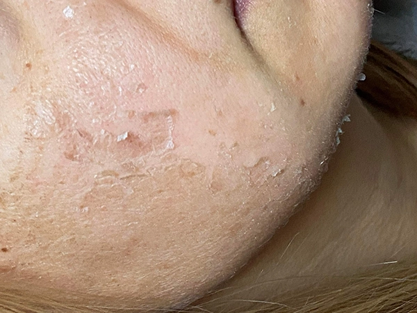 acne scar treatments hertford