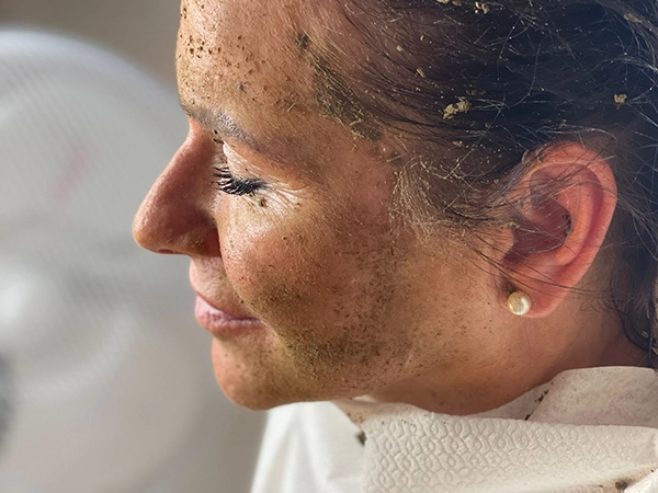 acne scar treatments ware