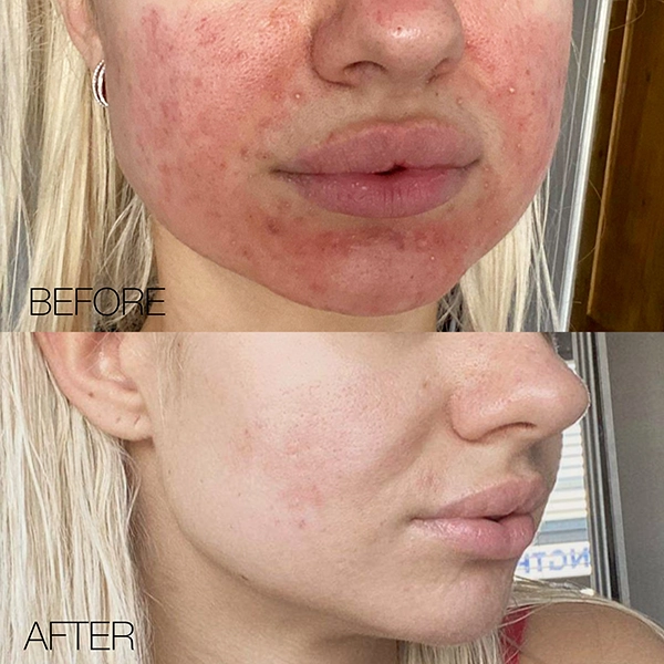 acne scars solution hertfordshire