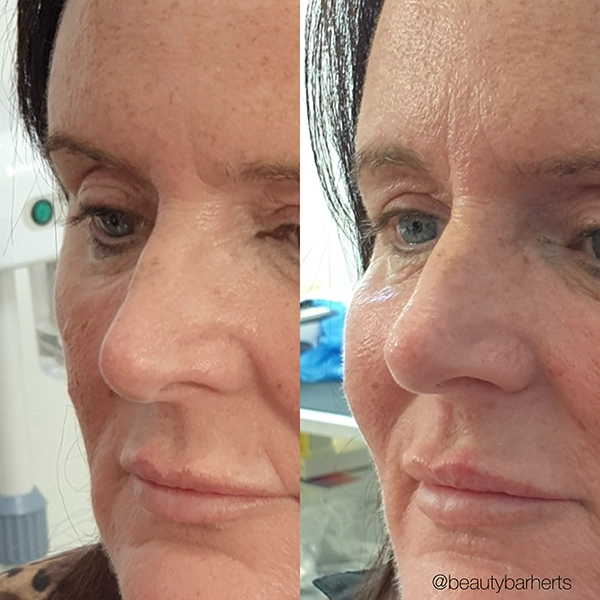 cheek filler expectations