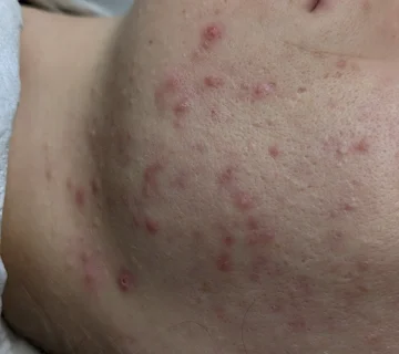 how to prevent acne scars hertfordshire