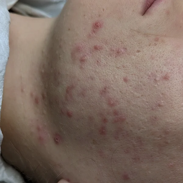 how to prevent acne scars hertfordshire