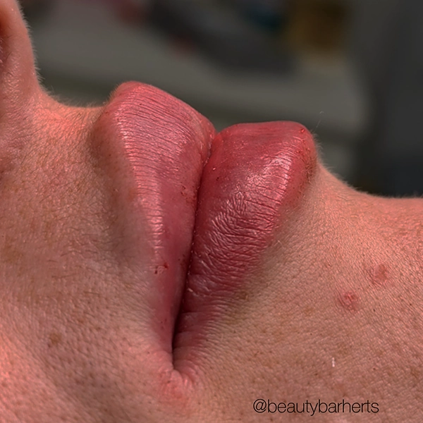 lip filler and semi permanent lip tattoo welwyn garden city