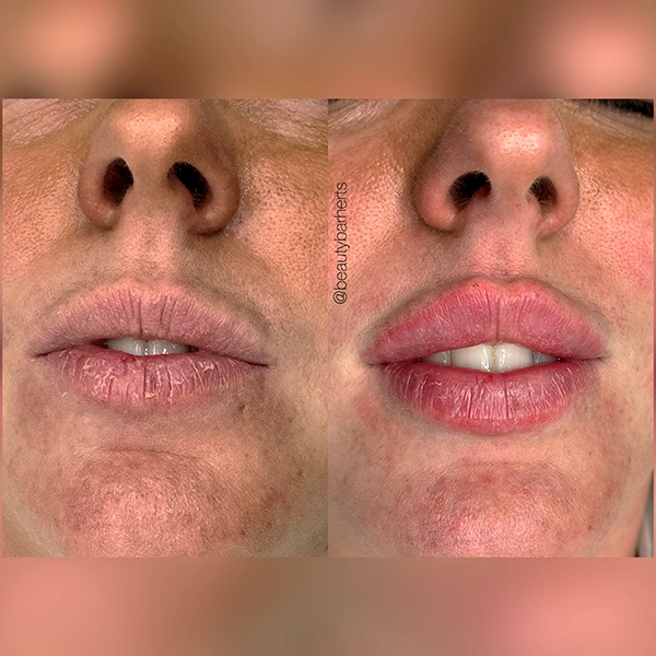 semi permanent lip and lip filler hertford