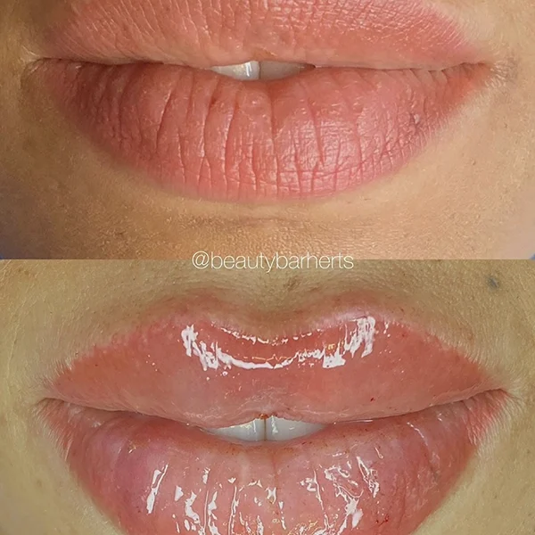 semi permanent lip tattoo and lip filler hertfordshire