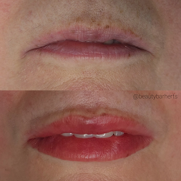 semi permanent lip tattoo with lip filler ware