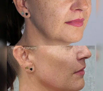what to expect during cheek filler hertfordshire
