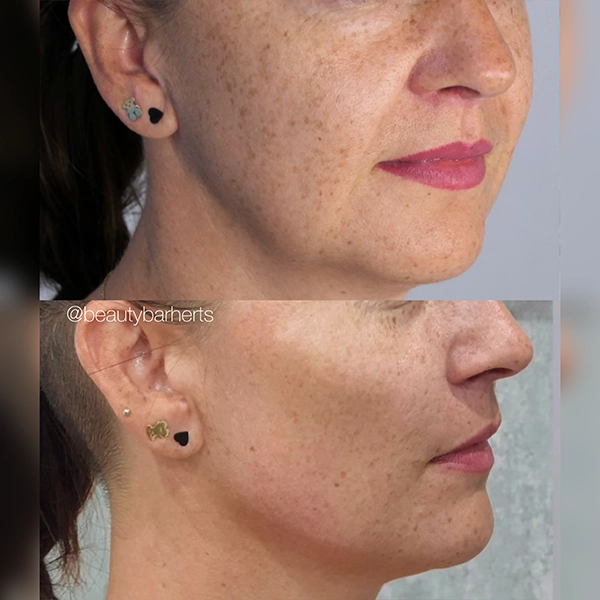 what to expect during cheek filler hertfordshire