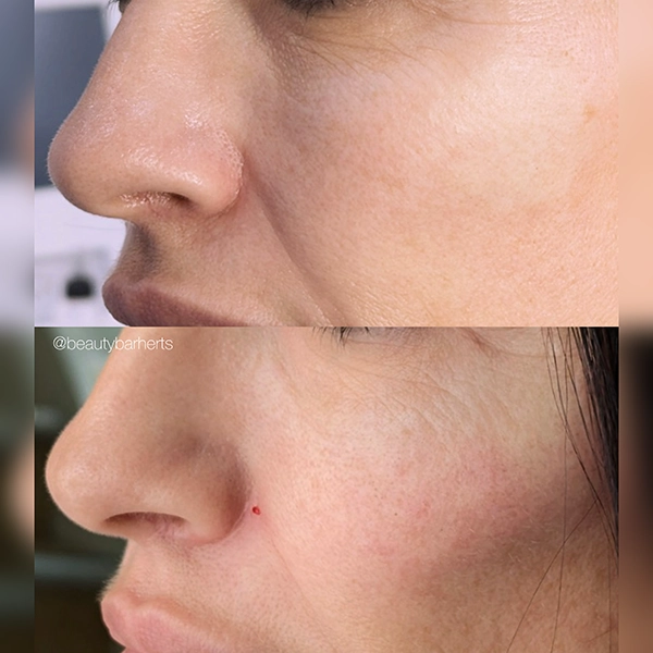 what to expect during cheek filler