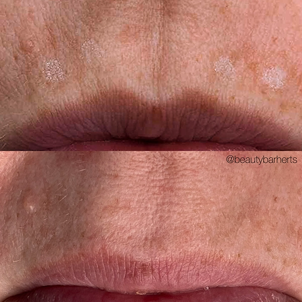 wrinkle prevention hertfordshire