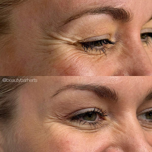 wrinkle prevention welwyn garden city