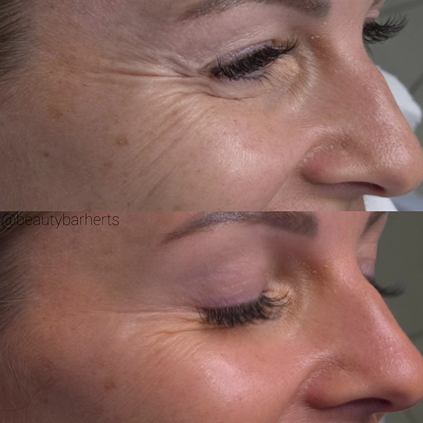 anti ageing prevention buntingford anti ageing prevention buntingford