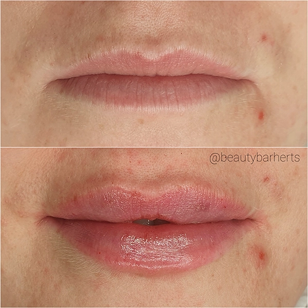 lip plumping buntingford lip plumping buntingford