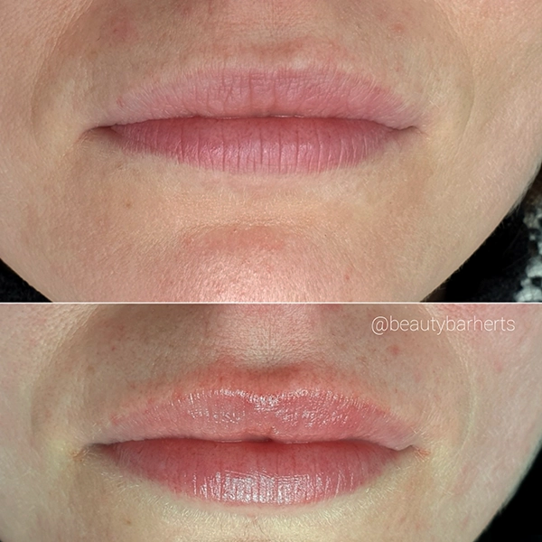 lip plumping hertfordshire lip plumping hertfordshire