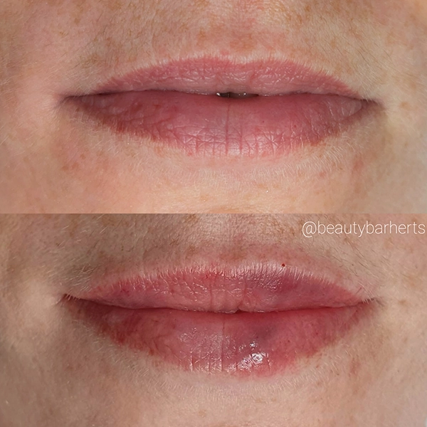 lip plumping ware lip plumping ware