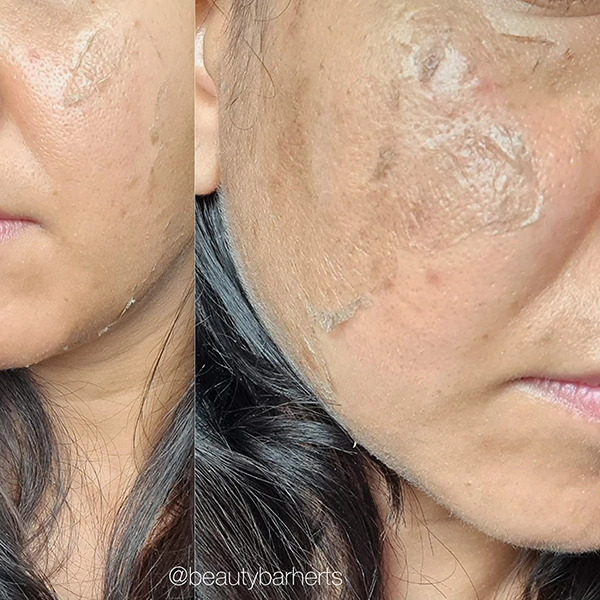 skin ageing preventive treatments hertfordshire skin ageing preventive treatments hertfordshire