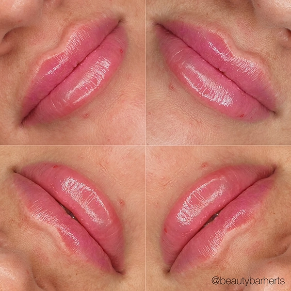 things you need to know about lip plumping treatments things you need to know about lip plumping treatments