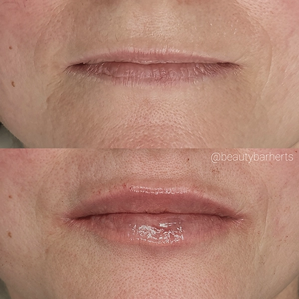 things you need to know about lip plumping things you need to know about lip plumping