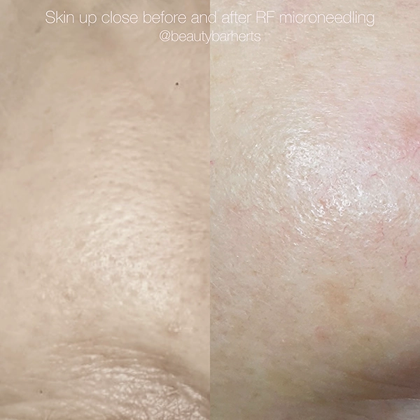 how to build collagen in skin welwyn garden city how to build collagen in skin welwyn garden city