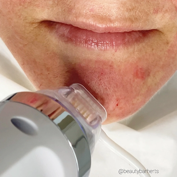 how to build collagen in your skin buntingford how to build collagen in your skin buntingford