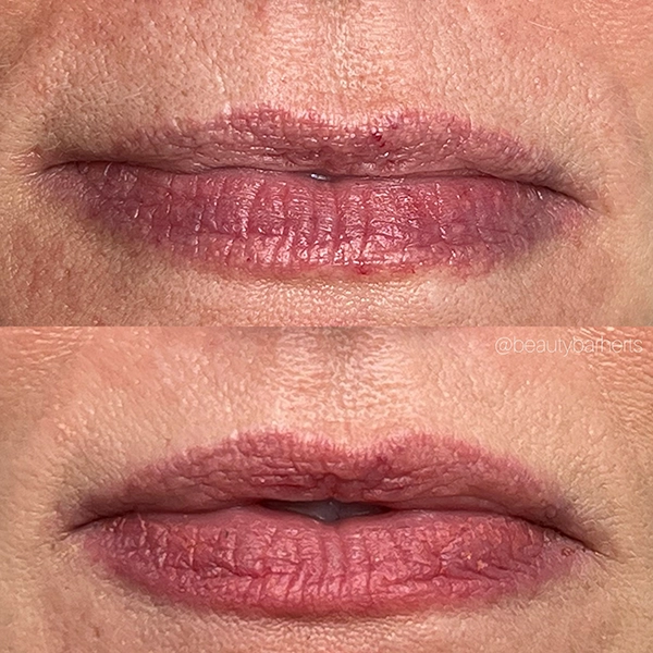 lip flip before after lip flip before after