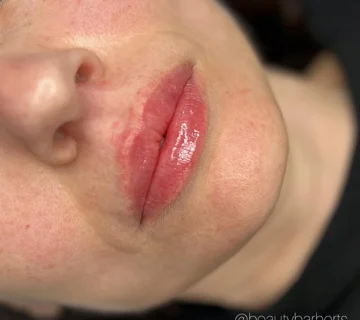 Lip flip vs lip filler hertfordshire