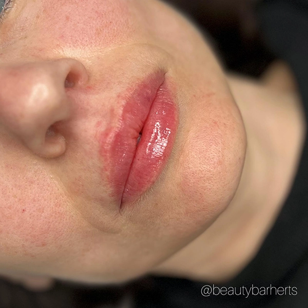 lip flip vs lip filler hertfordshire
