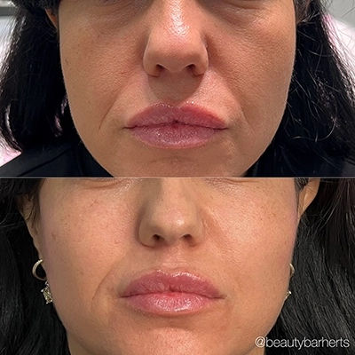 years younger face hertfordshire Years younger face hertfordshire