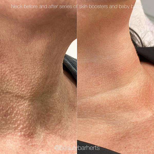 years younger neck Years younger neck