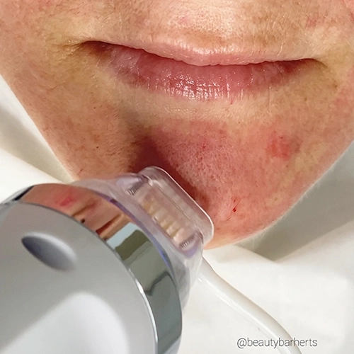 can microneedling rf improve skin buntingford Can microneedling rf improve skin buntingford