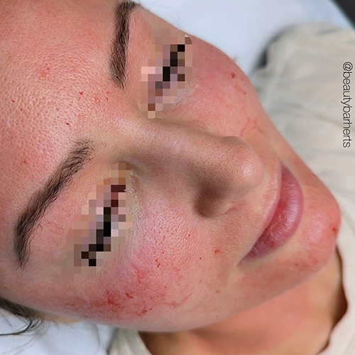 best rf microneedling stevenage Best rf microneedling stevenage