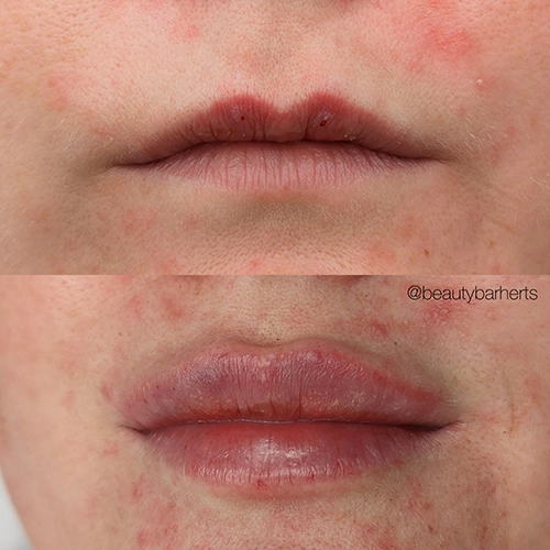 bruisisng after lip filler hertfordshire Bruisisng after lip filler hertfordshire