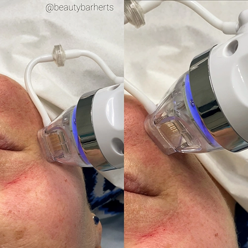 can fractional RF improve my skin royston Can fractional RF improve my skin royston