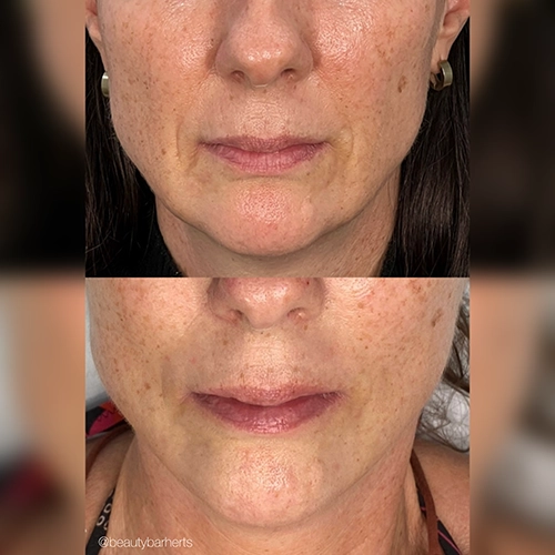 can rf microneedling prevent skin ageing ware Can rf microneedling prevent skin ageing ware