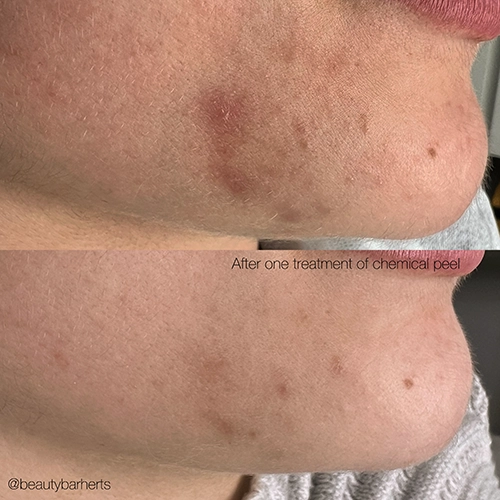 compare chemical peel tca ware Compare chemical peel tca ware