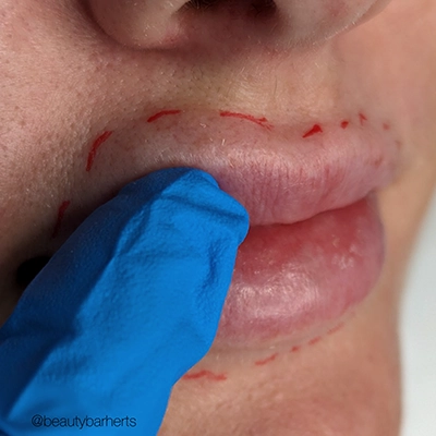 dermal filler side effects buntingford Dermal filler side effects buntingford