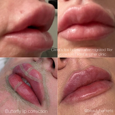 filler risks and side effects hertfordshire Filler risks and side effects hertfordshire