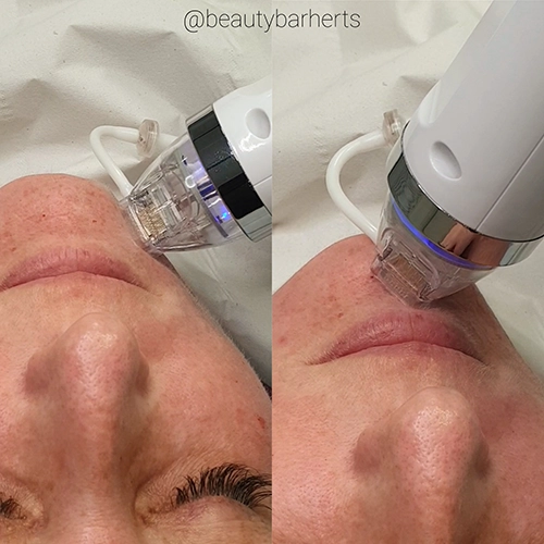 fractional RF vs microneedling hertfordshire Fractional RF vs microneedling hertfordshire