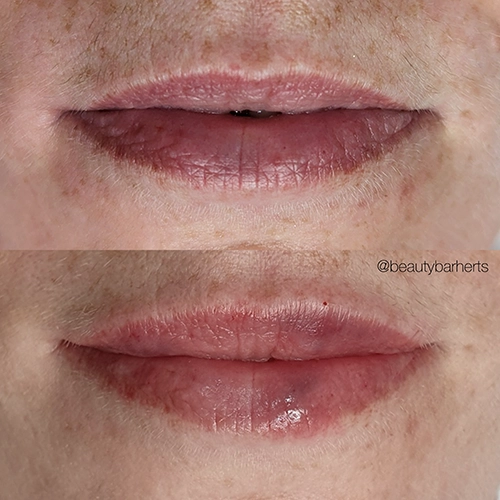 lip filler bruising royston Lip filler bruising royston
