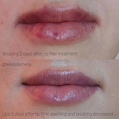 lip filler complications welwyn garden city Lip filler complications welwyn garden city