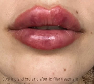 Lip filler side effects hertford