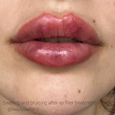 lip filler side effects hertford Lip filler side effects hertford