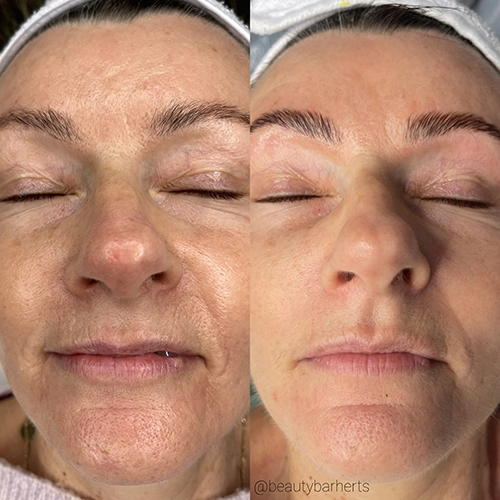 microneedling and RF needling buntingford Microneedling and RF needling buntingford