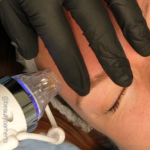 rf microneedling and microneedling compare beauty bar Rf microneedling and microneedling compare beauty bar