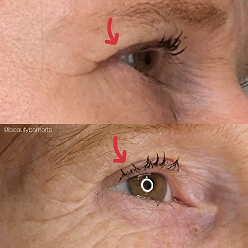 rf needling eye lift ware hertfordshire Rf needling eye lift ware hertfordshire