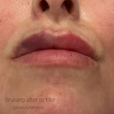 risks of lip filler royston Risks of lip filler royston