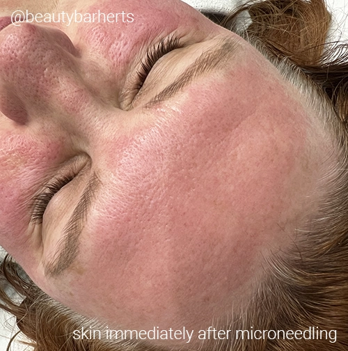 Skin immediately after microneedling hertford