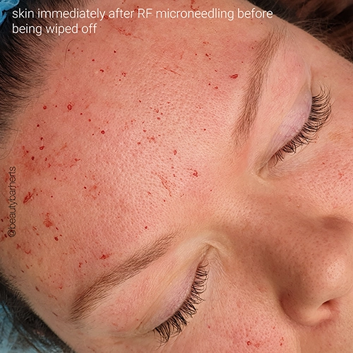 Skin immediately after rf microneedling stevenage