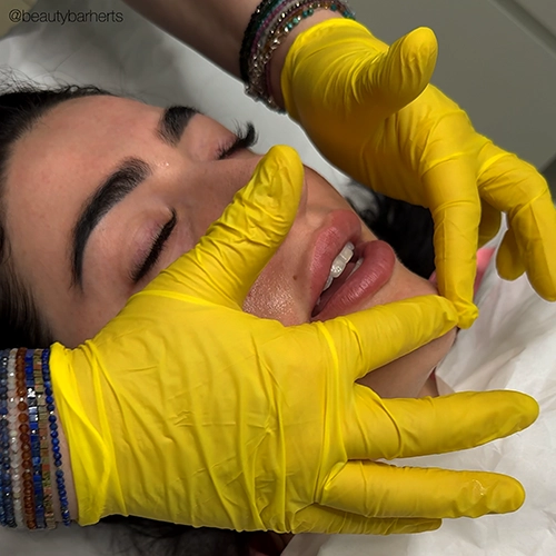 tca peels hertfordshire Tca peels hertfordshire